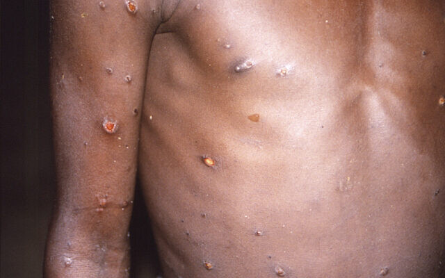 Illustrative: This 1997 image provided by CDC, shows the right arm and torso of a patient, whose skin displayed a number of lesions due to what had been an active case of monkeypox.   (CDC via AP)
