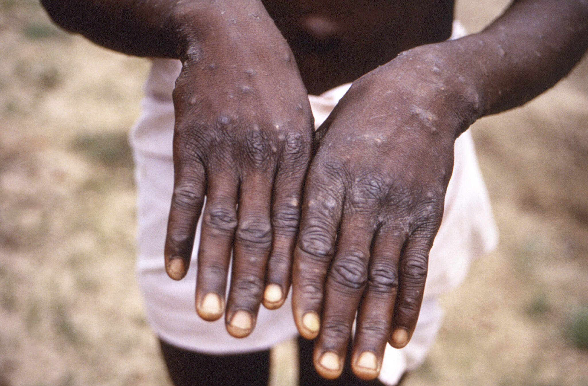 This 1997 image provided by the CDC during an investigation into an outbreak of monkeypox, which took place in the Democratic Republic of the Congo (DRC), formerly Zaire, and depicts the dorsal surfaces of the hands of a monkeypox case patient, who was displaying the appearance of the characteristic rash during its recuperative stage. (CDC via AP)