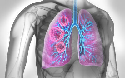 Medical Illustration of lung cancer, with a cancerous area in lungs (peterschreiber.media via iStock by Getty Images)