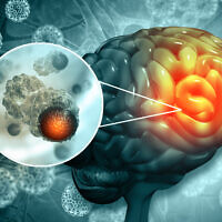 Illustrative: A human brain with a cancerous growth. (Mohammed Haneefa Nizamudeen; iStock by Getty Images)