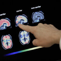 FILE - In this Aug. 14, 2018 file photo, a doctor looks at PET brain scans in Phoenix (AP Photo/Matt York, File)
