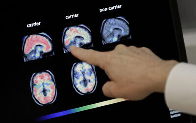 FILE - In this Aug. 14, 2018 file photo, a doctor looks at PET brain scans in Phoenix (AP Photo/Matt York, File)