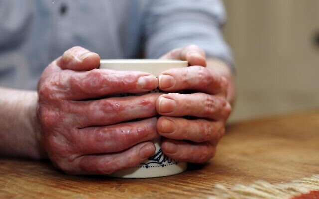 Illustrative photo of a man with burn wounds to his hands, December 2, 2015. (Jim Cole/AP)