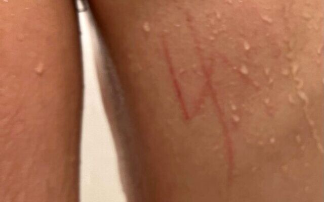 A swastika etched into the back of a US Jewish boy with special needs at a Las Vegas school, March 9, 2023. (Courtesy; used in accordance with Clause 27a of the Copyright Law)