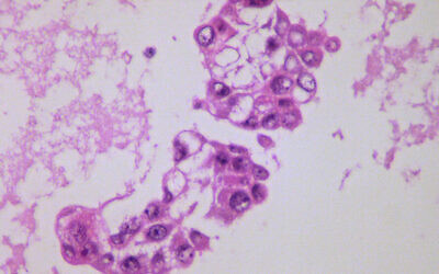 Illustrative: Metastatic ovarian adenocarcinoma- Pleural fluid cell block (Yale Rosen via Wikimedia Commons)
