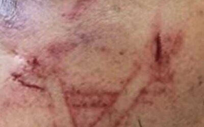 A photo released by police on August 19, 2023, shows cut marks on a Palestinian detainee's face that the force alleges was caused by an officers boot. A lawyer for the suspect alleges police branded him with a Star of David. (Israel Police)