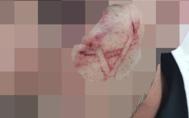 A Palestinian allegedly branded by Israel Police officers on August 18, 2023. (Courtesy)