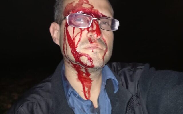 Alex Povolotsky, an activist with the Jordan Valley Activists group, bleeds profusely after being assaulted, allegedly by extremist settlers, in the Palestinian hamlet of Farasiya in the West Bank, December 4, 2023. (Courtesy Jordan Valley Activists)